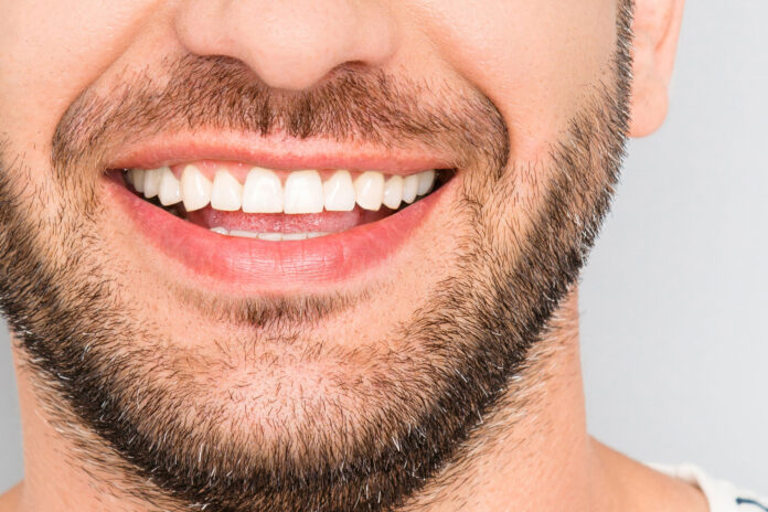 veneers